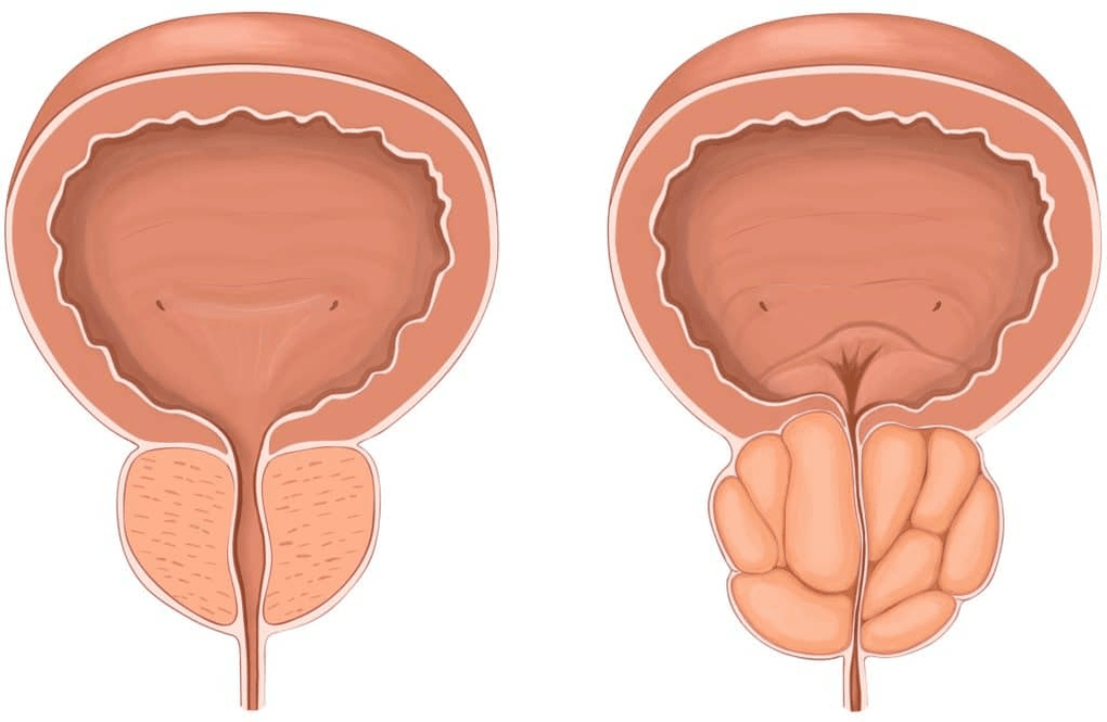 Kaj se zgodi s prostato med prostatitisom