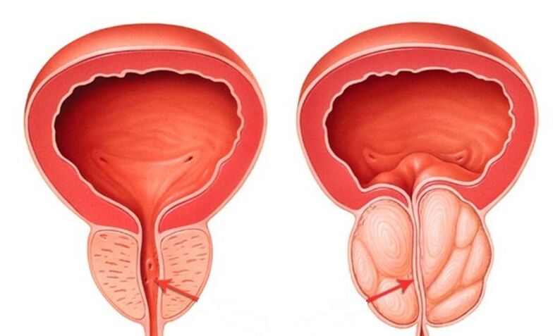 Zdrava in vneta prostata s prostatitisom
