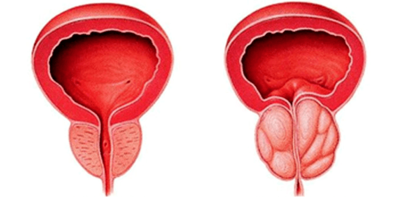 Normalna in vneta prostata